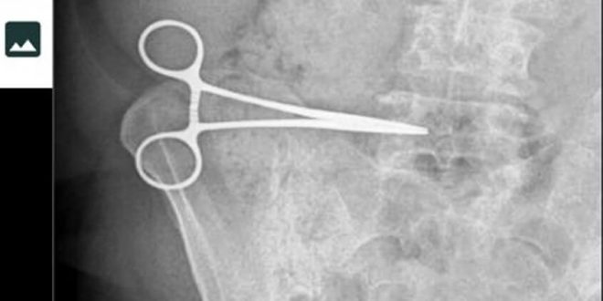 Aydın'da bir kadının ameliyat esnasında karnında unutulan makas operasyonla çıkarıldı